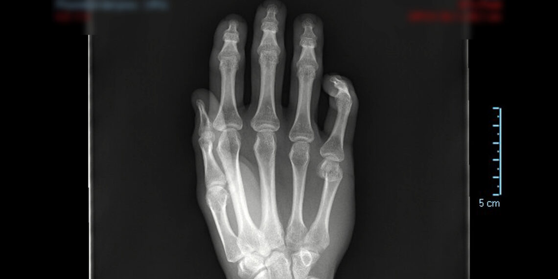 La patología del Miembro Superior es causa frecuente de consulta médica e incapacitación laboral