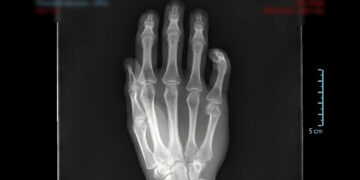 La patología del Miembro Superior es causa frecuente de consulta médica e incapacitación laboral