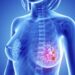 Un fármaco consigue frenar un cáncer de mama muy agresivo en el 75% de las pacientes