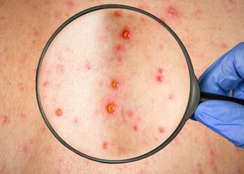 Sanidad valora la adquisición de vacunas para hacer frente a la viruela del mono