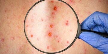 Sanidad valora la adquisición de vacunas para hacer frente a la viruela del mono