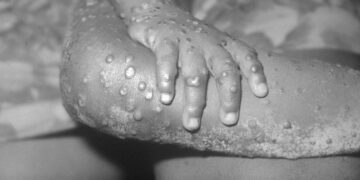 La viruela del mono ya está en la Costa del Sol