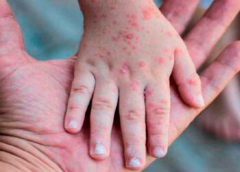 Más de la mitad de los casos de la viruela del mono se registran en la provincia de Málaga