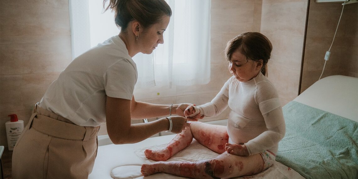 Las familias con hijos con Piel de Mariposa: «Lo más difícil es verlos sufrir cada día»