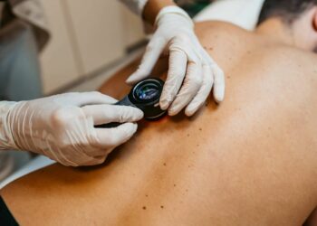 Desarrollan un modelo para detectar de forma temprana el cáncer de piel más agresivo