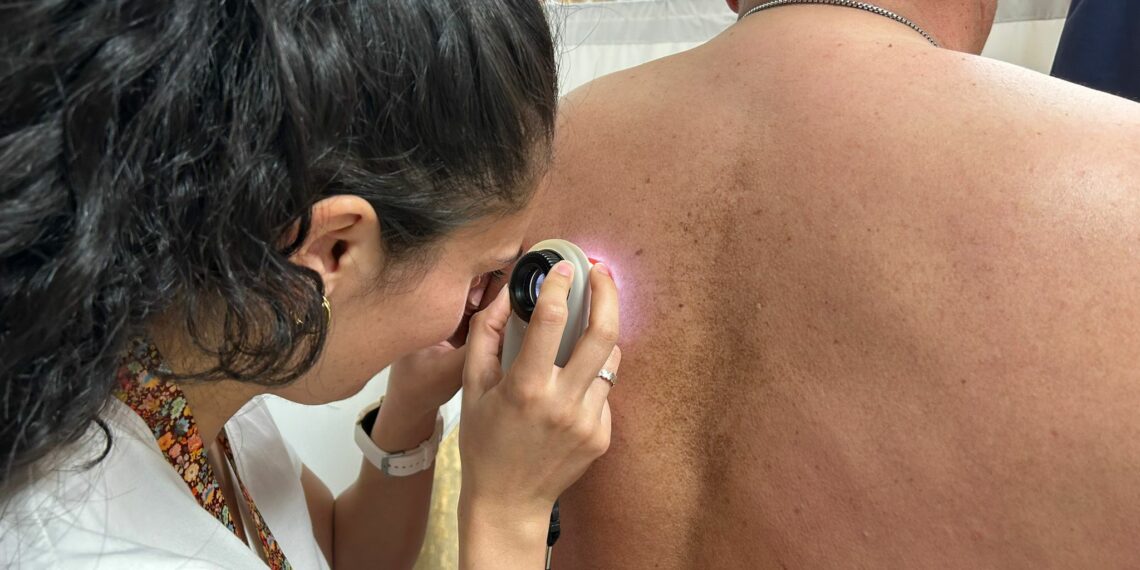El servicio de Dermatología del Hospital Universitario Costa del Sol detectó un melanoma cada dos días en 2023