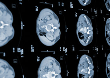 Un ensayo muestra resultados prometedores contra el cáncer de páncreas metastático