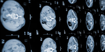 Un ensayo muestra resultados prometedores contra el cáncer de páncreas metastático