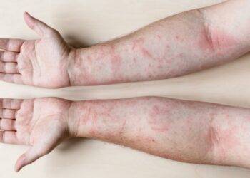 Descubren la causa principal del lupus y una posible forma de revertirlo