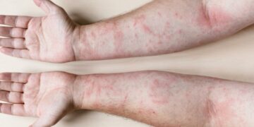 Descubren la causa principal del lupus y una posible forma de revertirlo