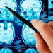 Crean unos nanorrobots que podrían ayudar a curar los aneurismas cerebrales