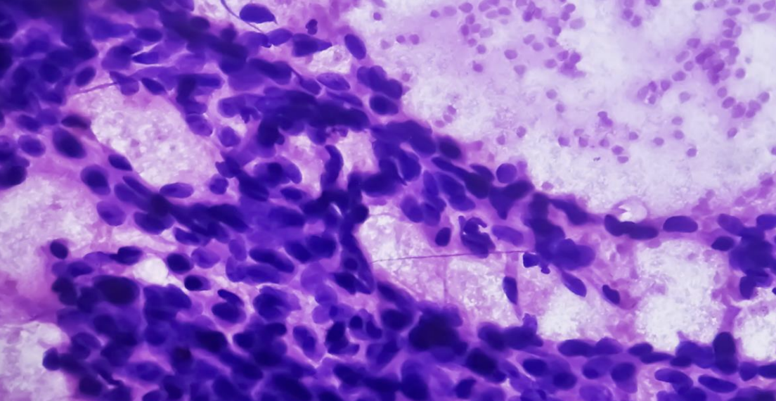 Investigadores del CSIC desarrollan una técnica innovadora para detectar células de cáncer de mama