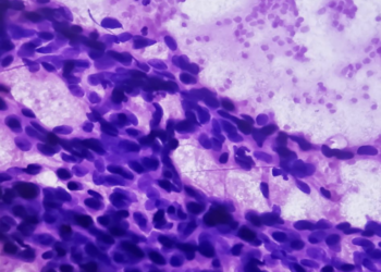 Investigadores del CSIC desarrollan una técnica innovadora para detectar células de cáncer de mama