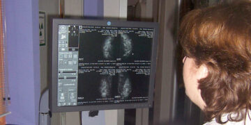 El cáncer de mama centra la mayor parte de las investigaciones oncológicas que se realizan en la sanidad pública