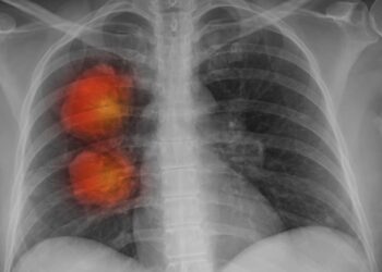 Un estudio genera esperanzas de tratar cánceres agresivos al eliminar el ADN rebelde