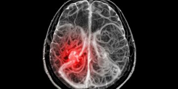 Logran tratar con éxito cánceres cerebrales infantiles incurables