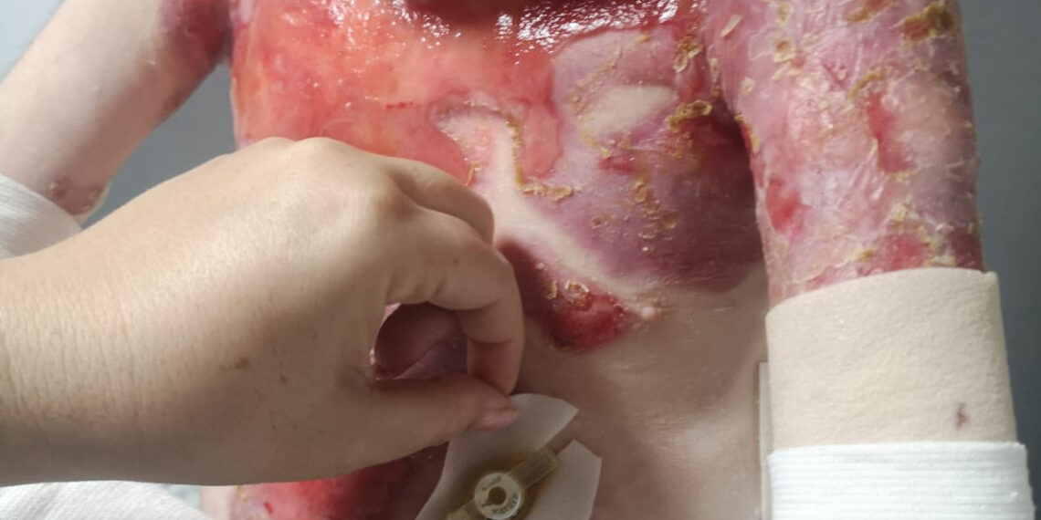 Un halo de esperanza: aprueban un medicamento pionero para la Piel de Mariposa