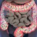 La microbiota intestinal, clave en la relación entre obesidad y cáncer colorrectal