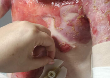 Familias con Piel de Mariposa exigen que España financie la terapia génica aprobada en Europa