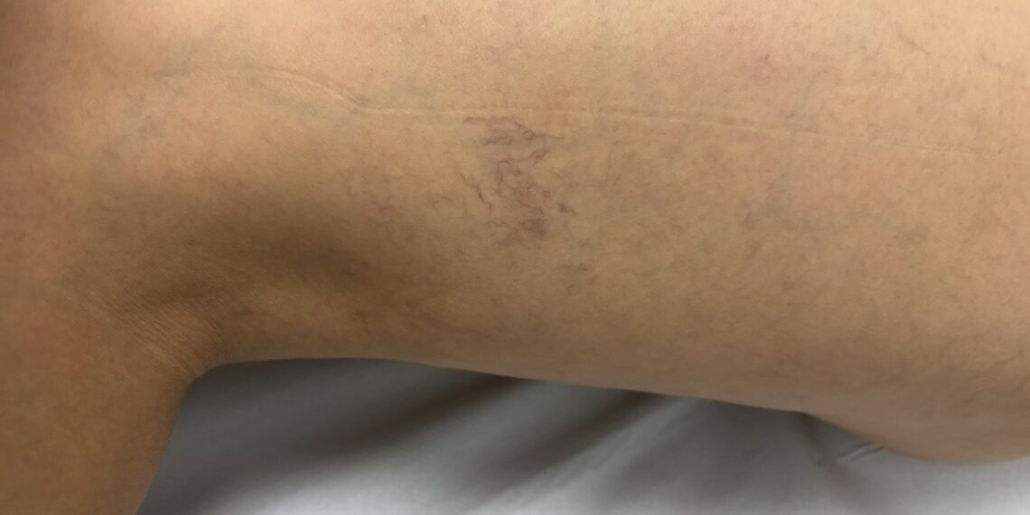 Medidas de higiene venosa como una buena hidratación, el ejercicio físico y bajar de peso ayudan a controlar la sintomatología de las varices