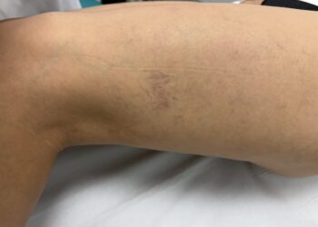 Medidas de higiene venosa como una buena hidratación, el ejercicio físico y bajar de peso ayudan a controlar la sintomatología de las varices