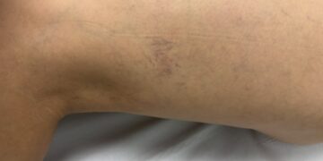 Medidas de higiene venosa como una buena hidratación, el ejercicio físico y bajar de peso ayudan a controlar la sintomatología de las varices